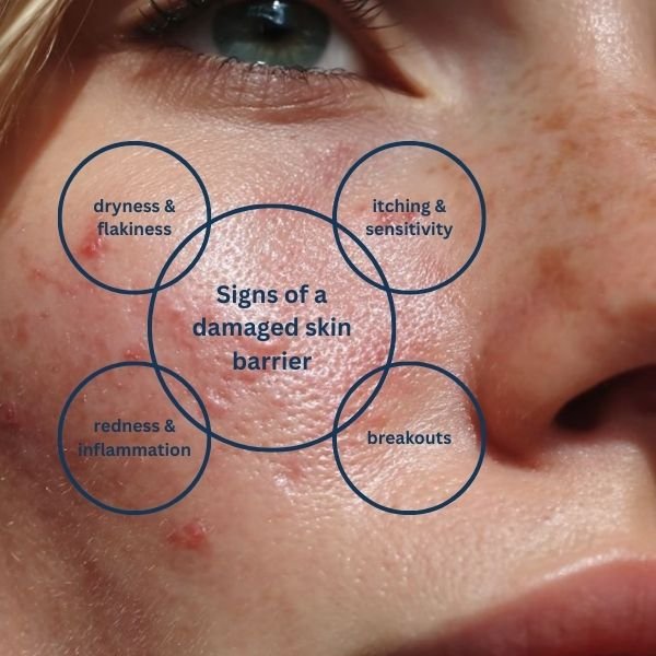 Skin barrier damage diagram