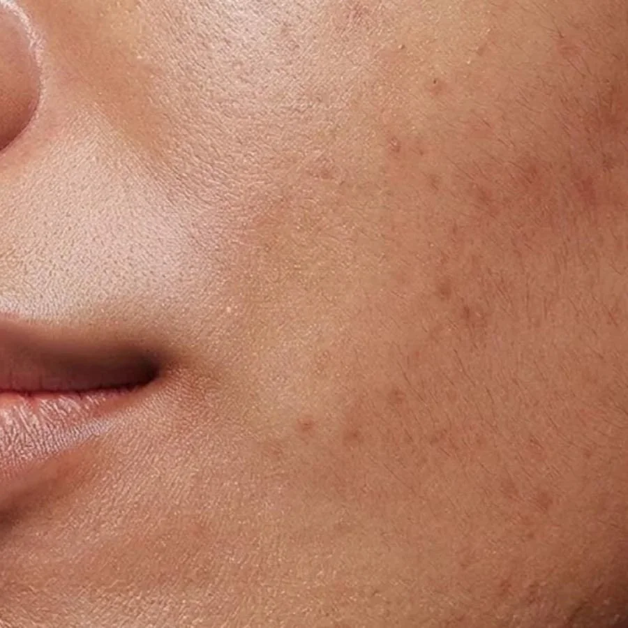 Hyperpigmentation 101: What Causes It and How to Treat Uneven Skin Tone