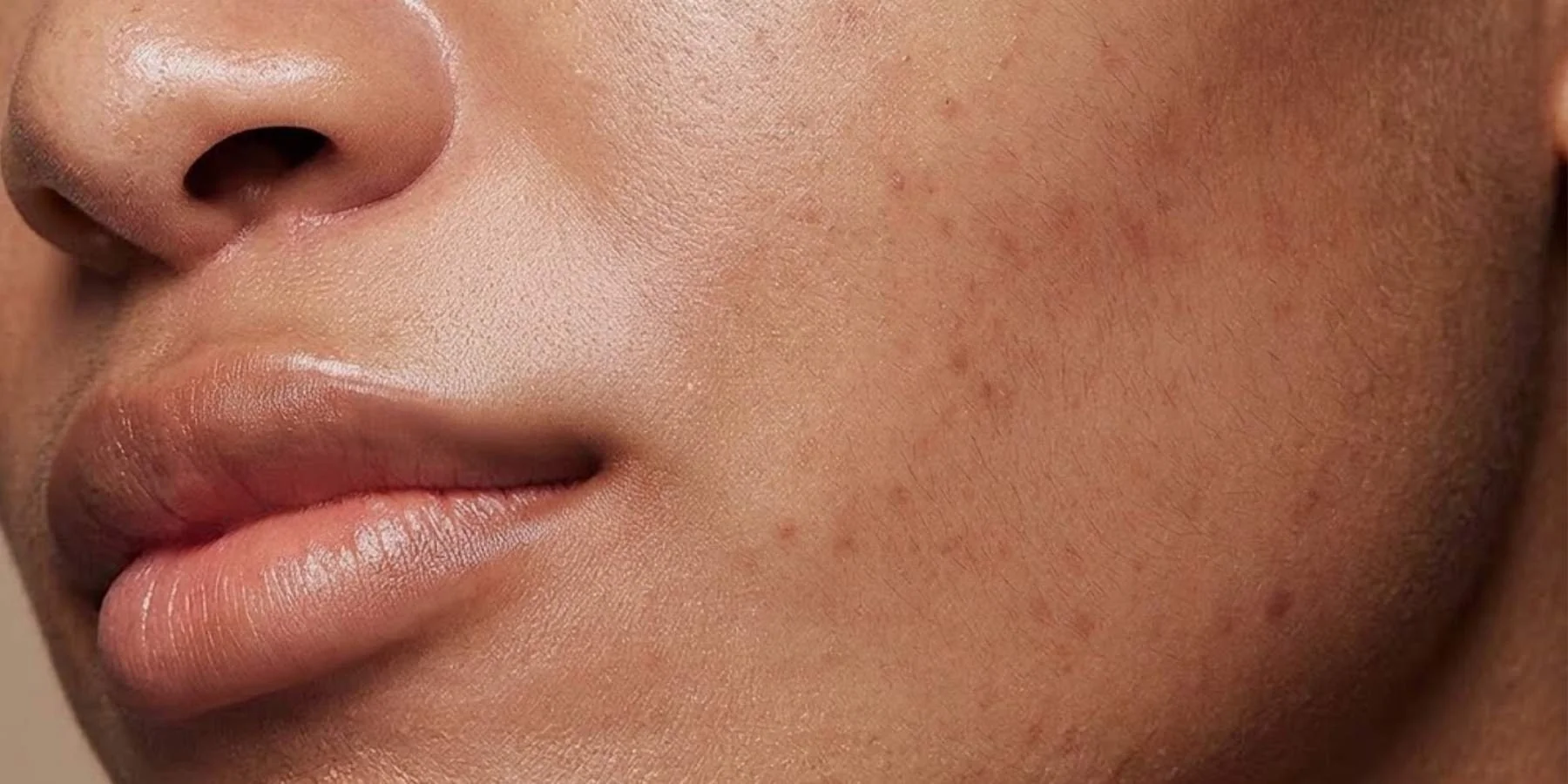 Hyperpigmentation on Cheek