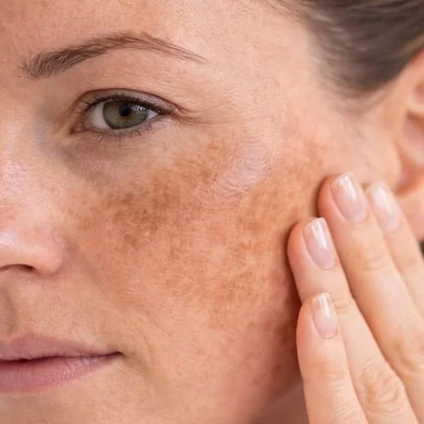Melasma on Cheek