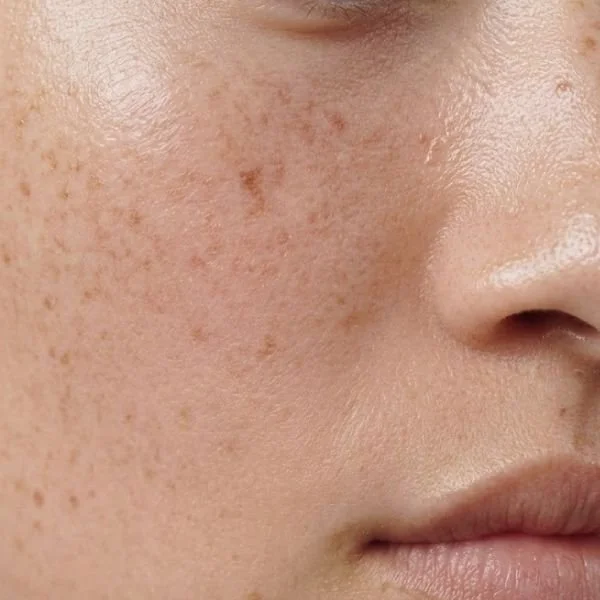 Hyperpigmentation on Cheek