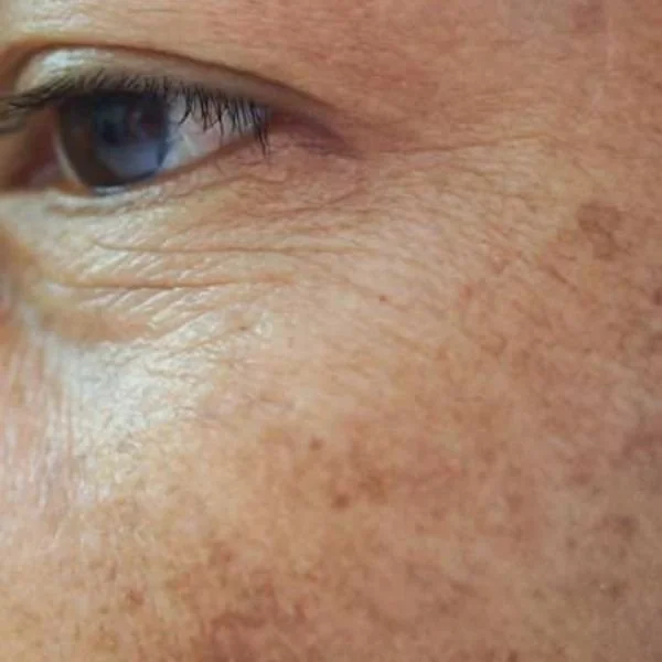 A close up of a woman's hyperpigmentation on her cheek