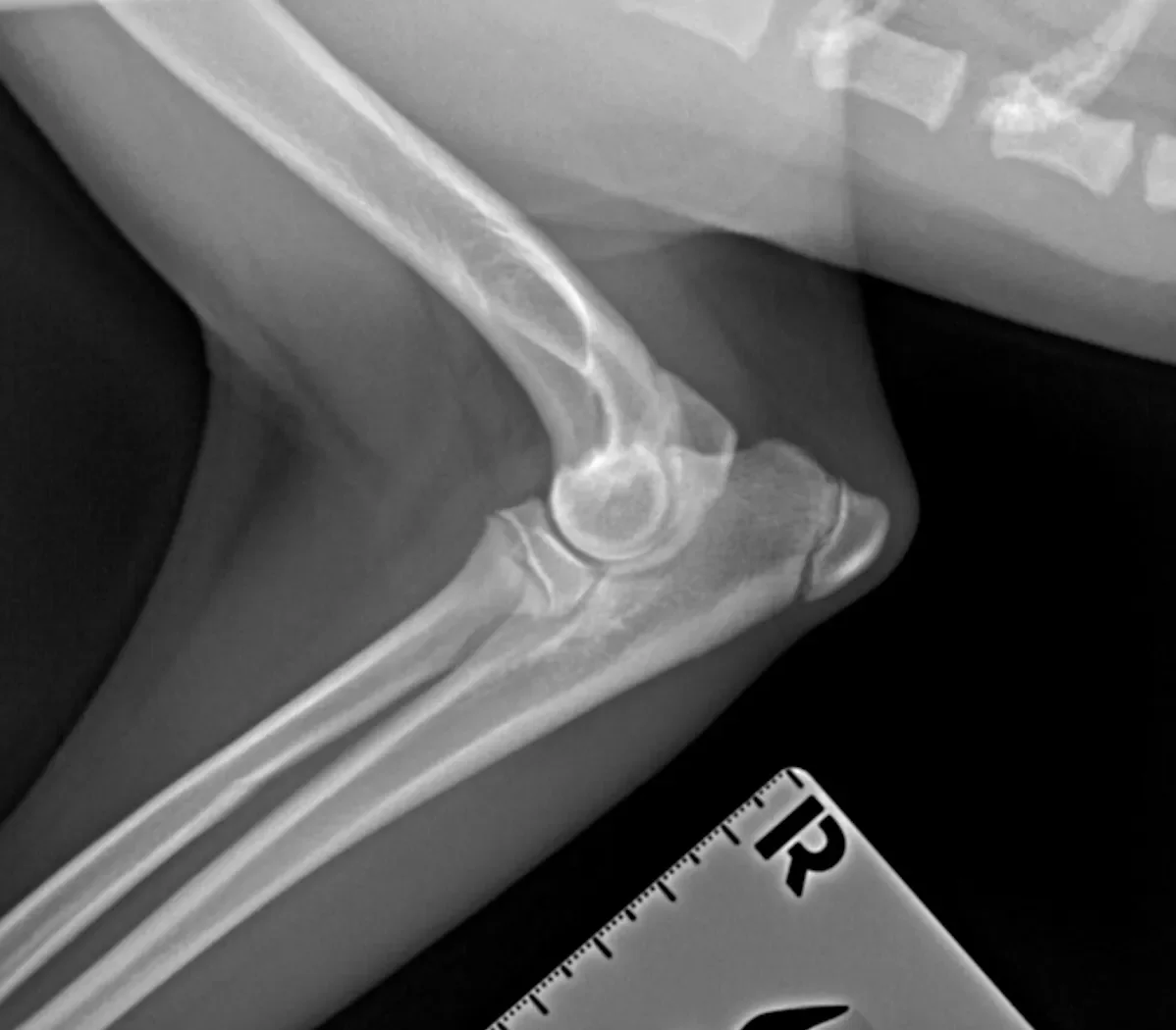 X-ray image of a human elbow showing the bones and joint, with a ruler for scale.