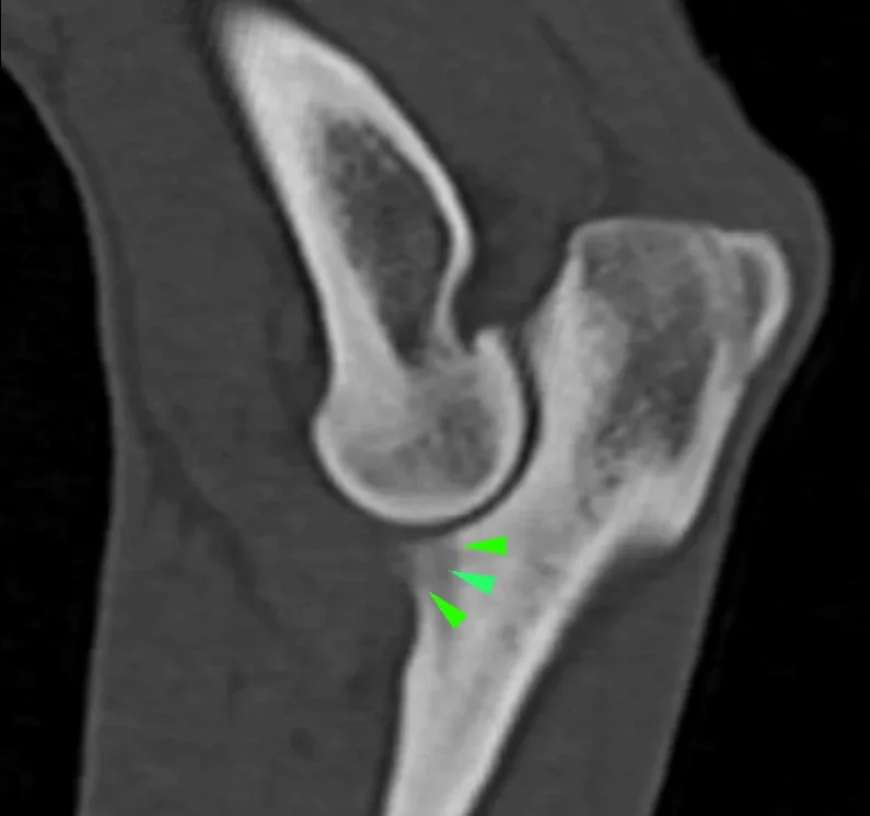 Vesper Coronoid process