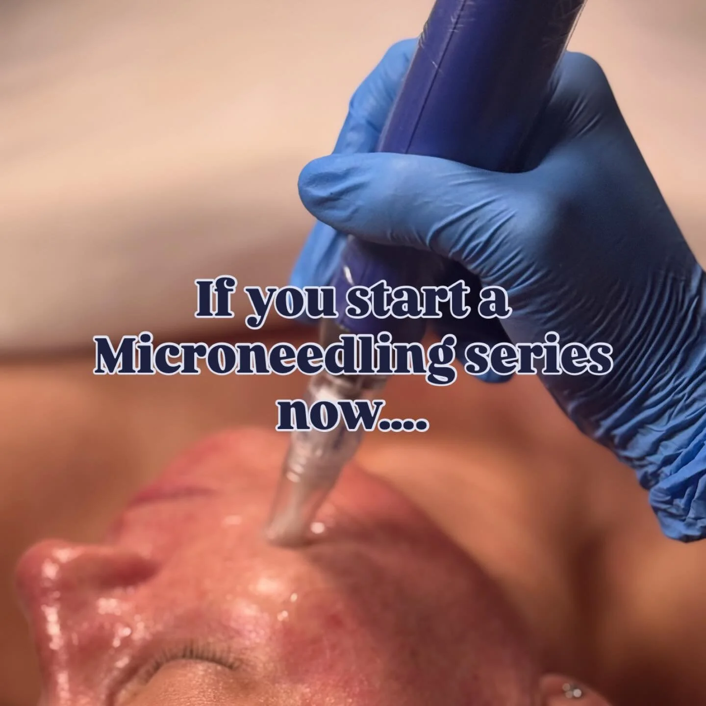 Your holiday glow starts with SkinPen 🎄✨

When you begin your microneedling series today, by the holidays your skin can be:
&bull; More radiant and bright
&bull; Smooth and refined
&bull; Youthful looking
&bull; Balanced in tone
&bull; Fine lines so