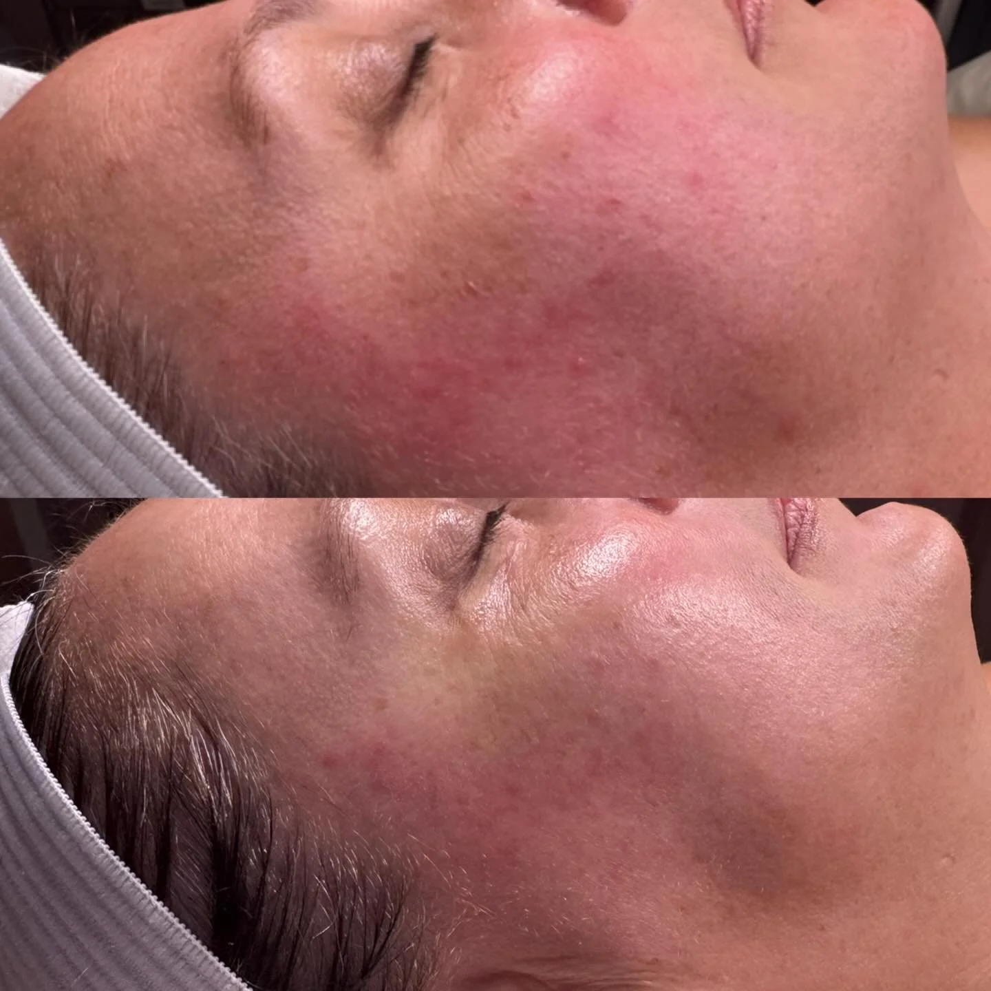 One session of Microneedling down.. and this makes me even  more excited for more! 🙌

Microneedling is the perfect treatment for inflammation. That inflammation could be Rosacea, redness, acne, or even melasma. This is the part that surprises a lot 