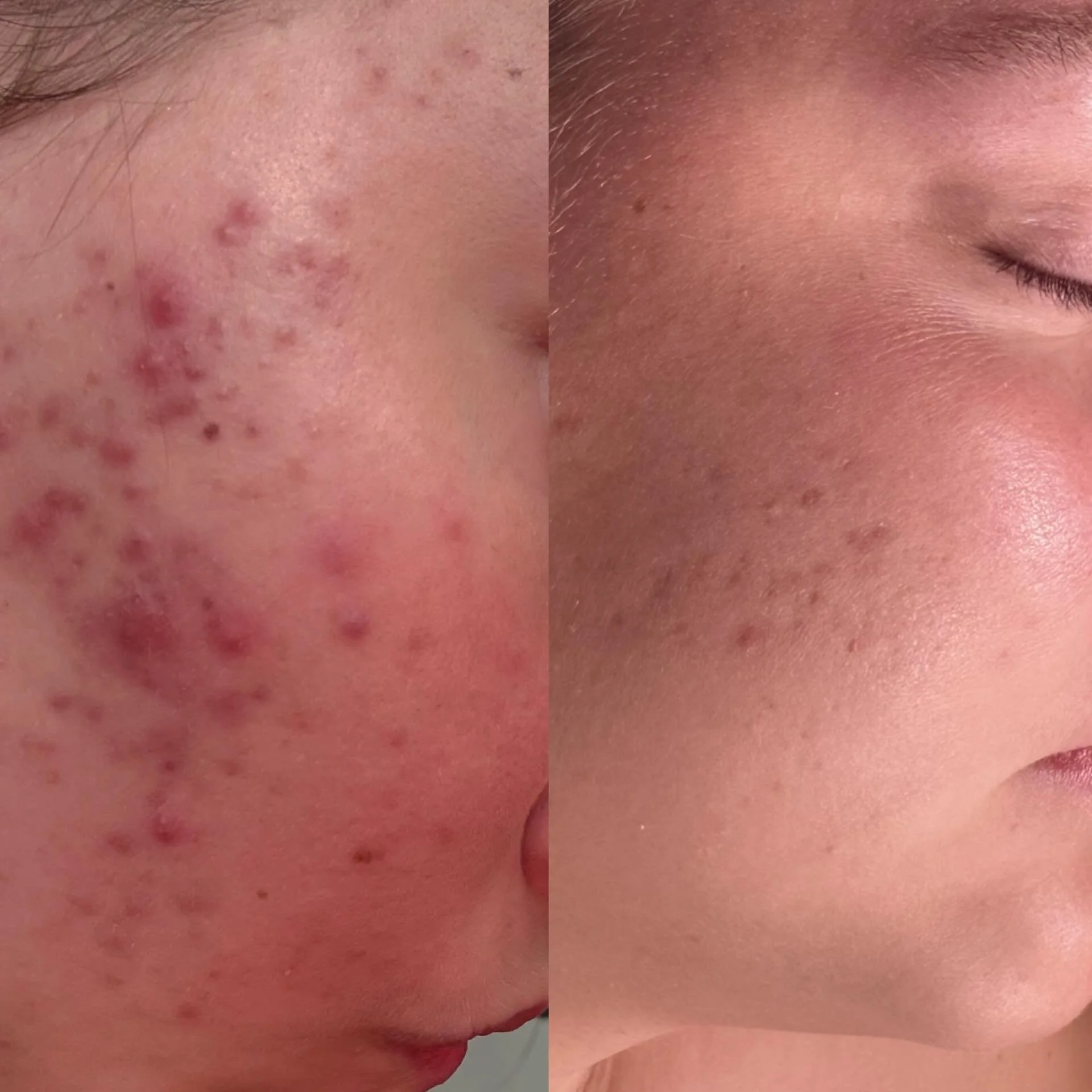 When you start with barrier health > move to corrective treatment = magic happens 🪄

December > May
This is just one Microneedling down we have two more to go 💁&zwj;♀️

Skincare + Peels @facerealityskincare
Microneedling @skinpen