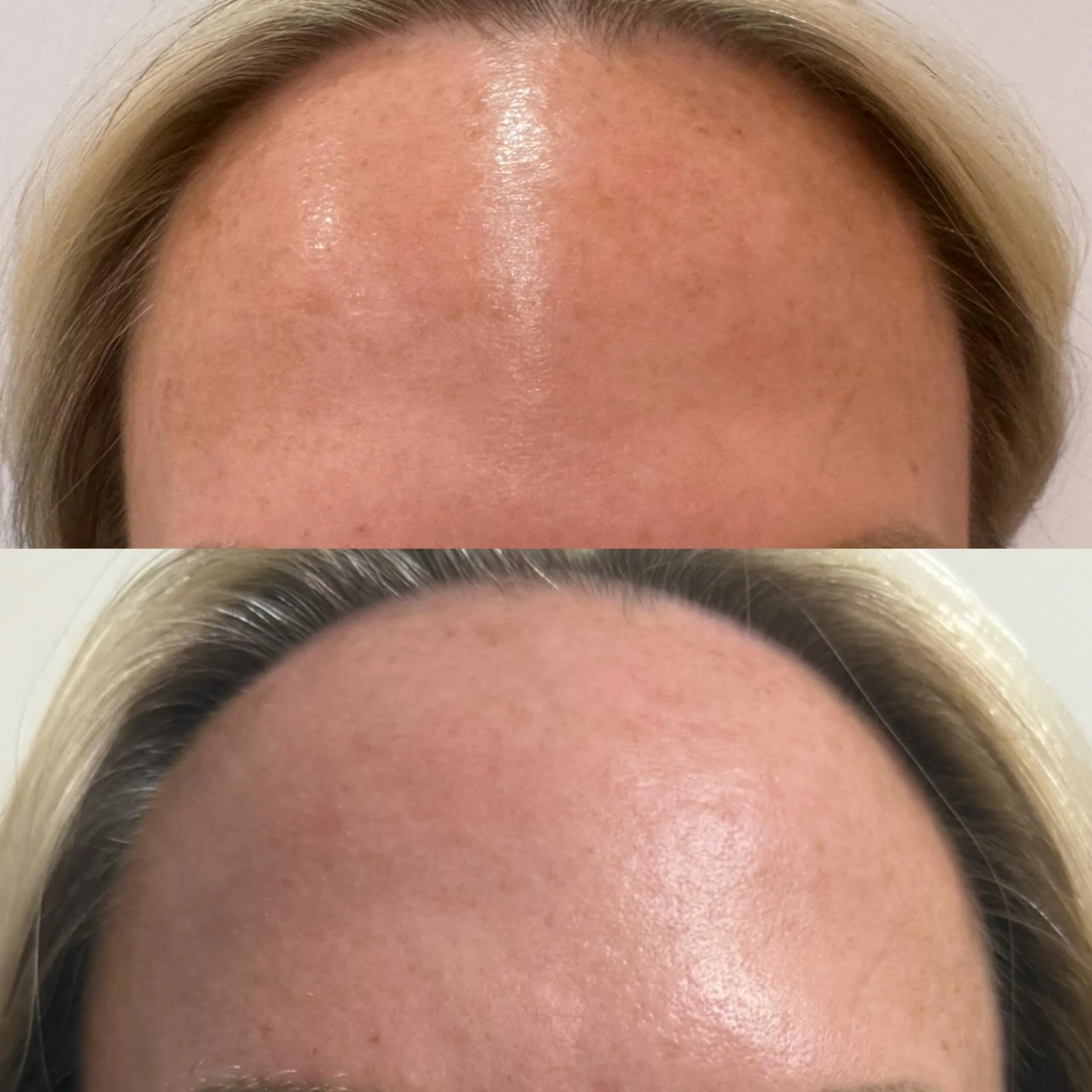Your skin called- it&rsquo;s ready for a refresh✨

Erasing pigment, smoothing texture and bettering the overall quality of skin.

Laser is running hot this month🥵👏