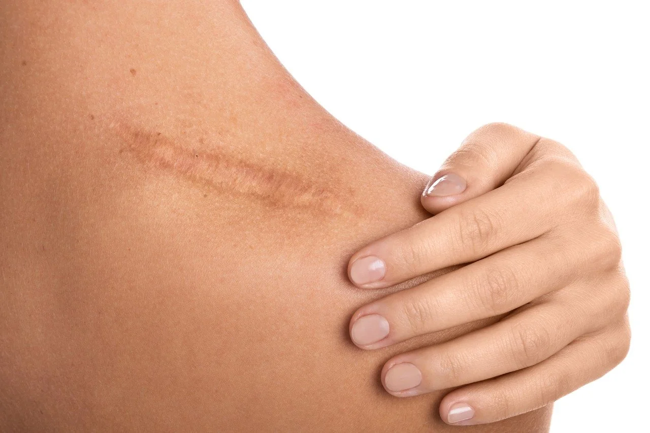 Close-up of a person's arm with a healing surgical scar, being gently touched by their hand.