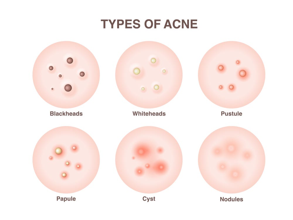 Types and causes of Acne (Part 2) — Your Site Title