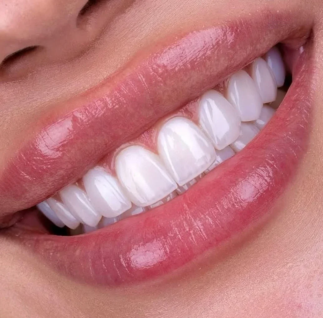 Transform Your Smile with Dental Veneers in Dubai