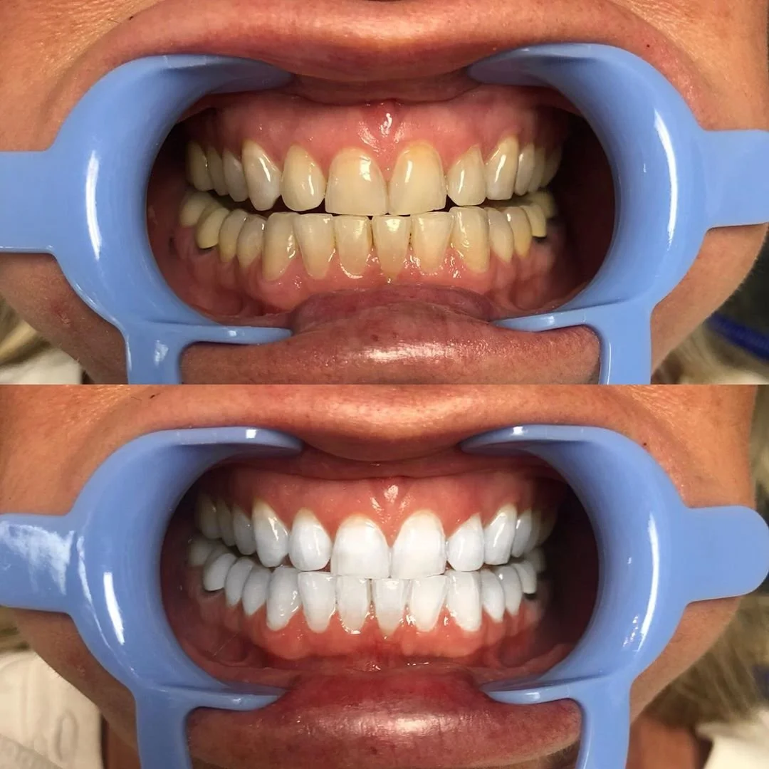 A person's mouth showing before and after teeth whitening, with the upper and lower teeth separated by a blue dental retractor in each image.