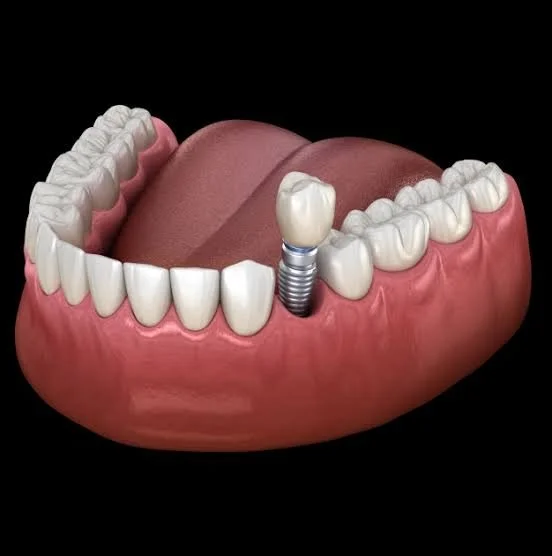 3D illustration of a dental implant replacing a missing tooth, representing dental implant treatment in Dubai.