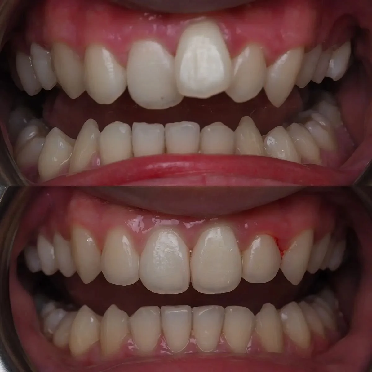 Comparison of teeth before and after dental cleaning showing improved appearance and reduced plaque.