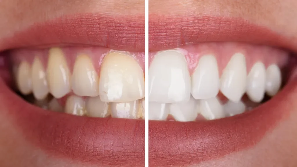 General dentist performing professional teeth whitening treatment at a dental clinic in Dubai.