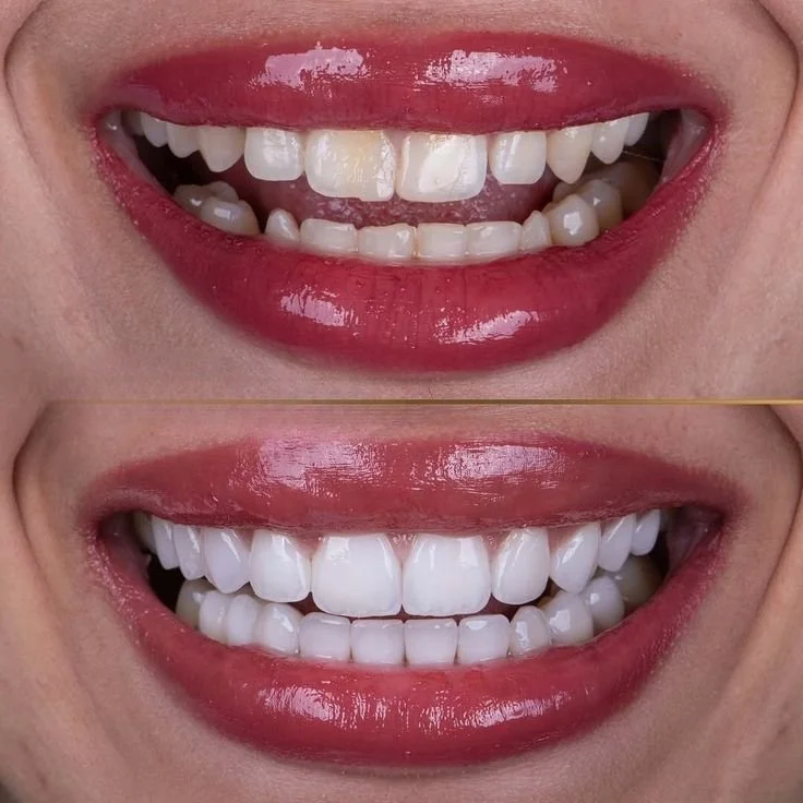 Close-up of a person's smiling mouth, showing a before and after comparison of dental whitening, with the top image showing stained teeth and the bottom image showing bright white teeth.