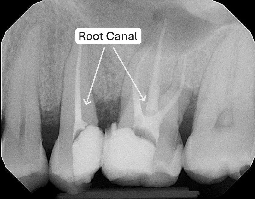Dentist performing root canal treatment at a dental clinic in Dubai.