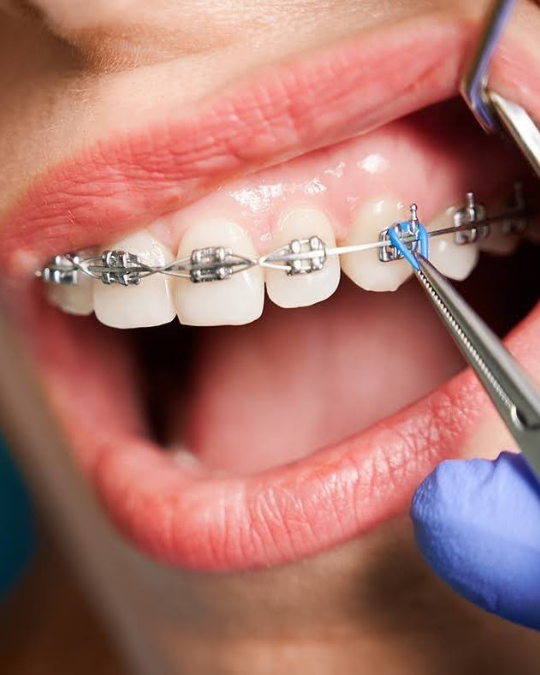 Orthodontist adjusting a patient’s braces at a dental clinic in Dubai.