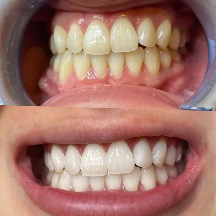Comparison of teeth before and after dental cleaning, showing cleaner, whiter teeth in the bottom image.