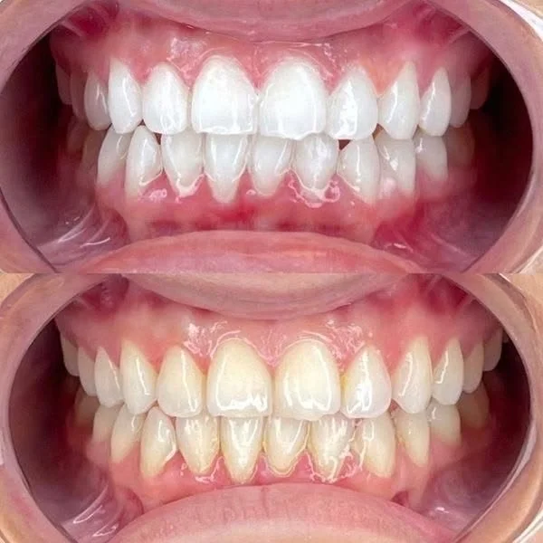 Close-up of a person's teeth before and after dental cleaning or whitening, showing improved brightness and alignment in the lower image.