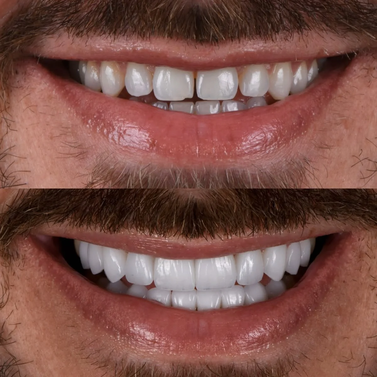Comparison of a person's mouth before and after dental treatment showing improved white teeth.