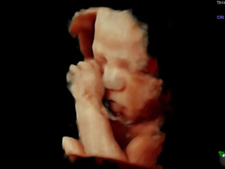Peek a Boo 3D/4D Ultrasound