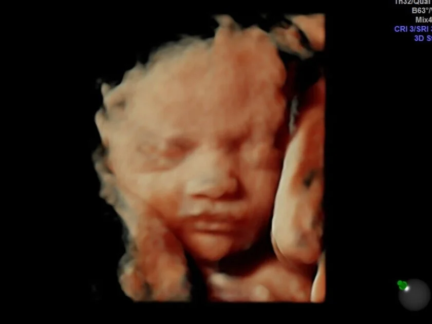 3D 4D Ultrasound Perth