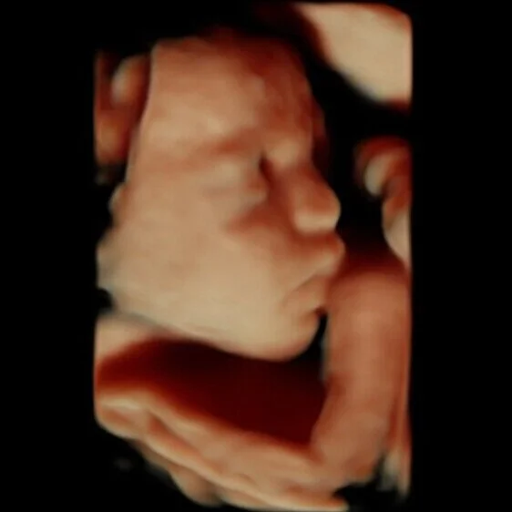 Peek a Boo 3D/4D Ultrasound
