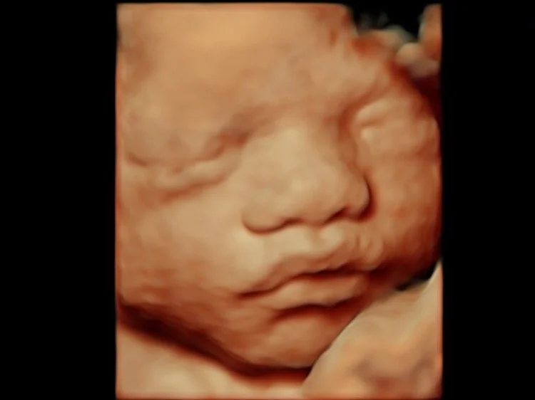 Peek a Boo 3D/4D Ultrasound