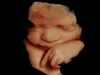 Peek a Boo 3D/4D Ultrasound