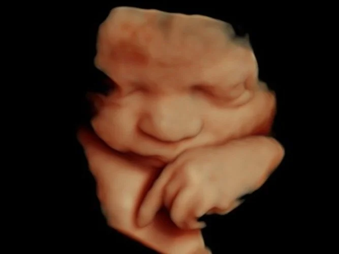 Peek a Boo 3D/4D Ultrasound
