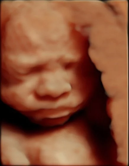 Peek a Boo 3D/4D Ultrasound