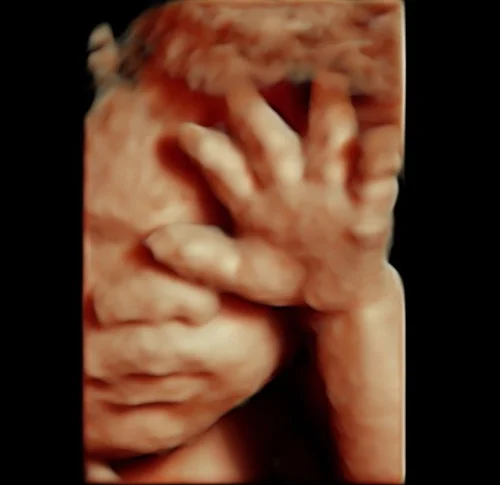 Peek a Boo 3D/4D Ultrasound