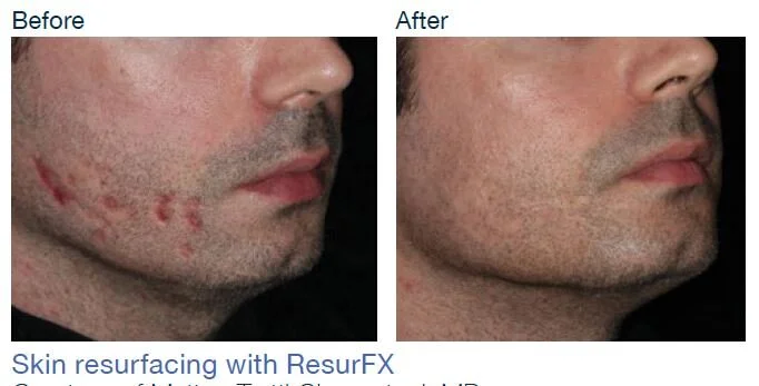 Skin resurfacing pic.JPG