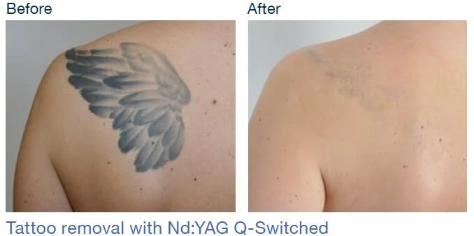Tattoo removal pic.JPG