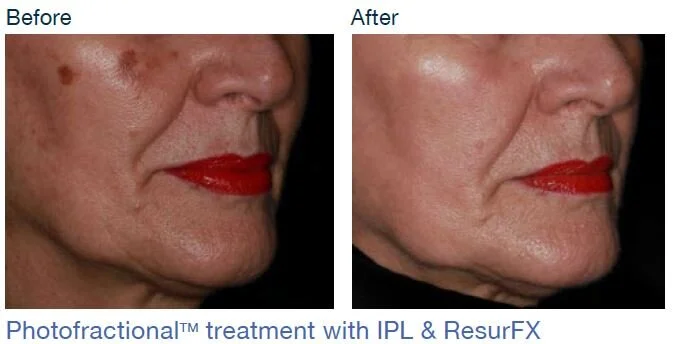 Photfractional pic.JPG