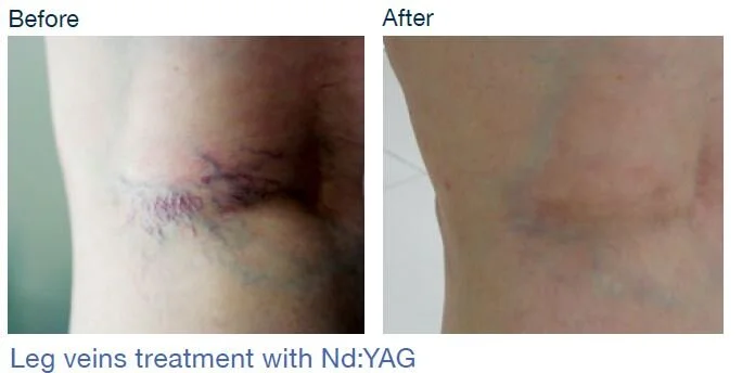 Leg Veins pic.JPG