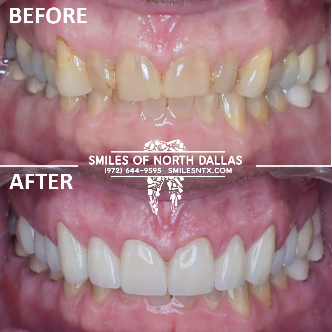 Upper Full Veneers