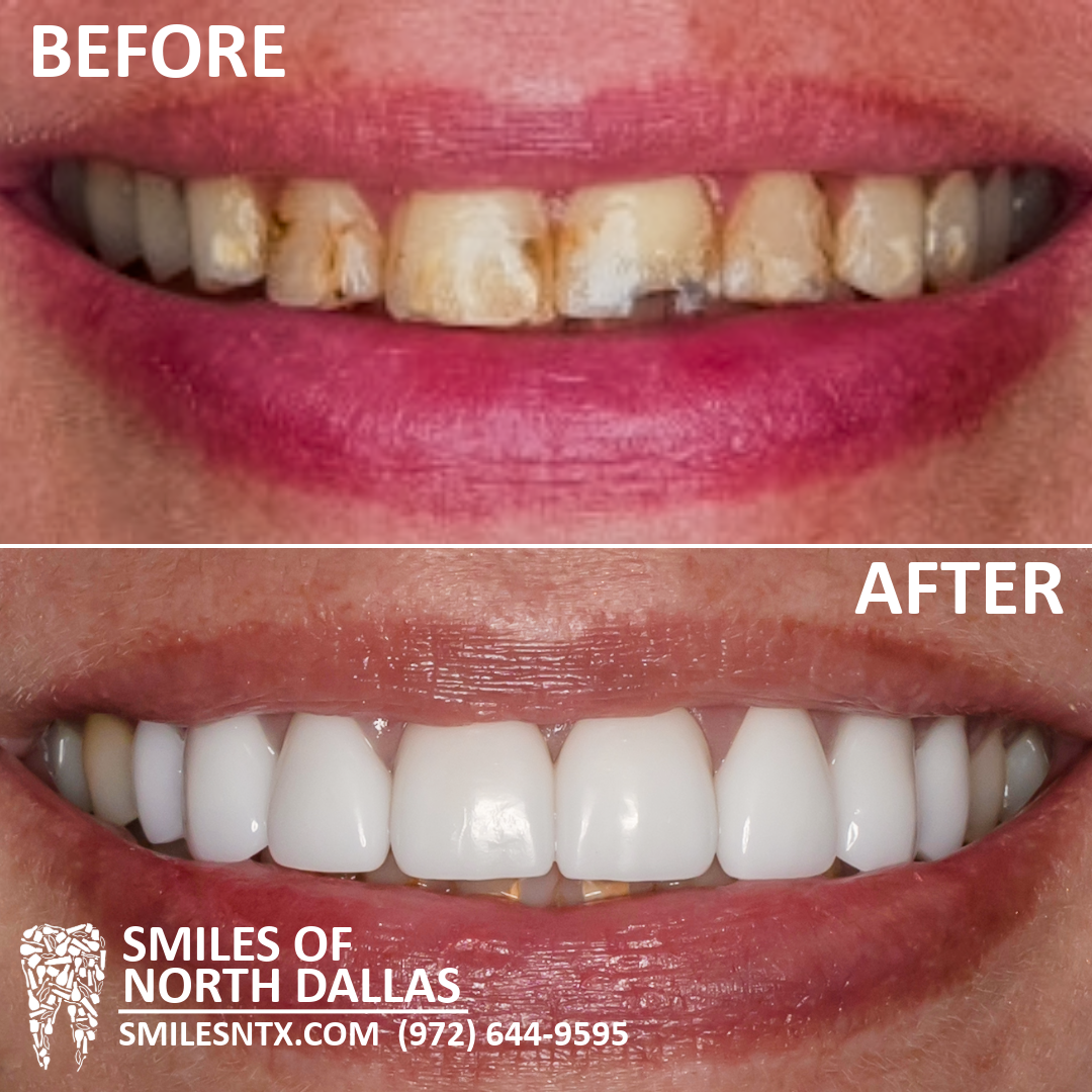 Full Upper Veneers