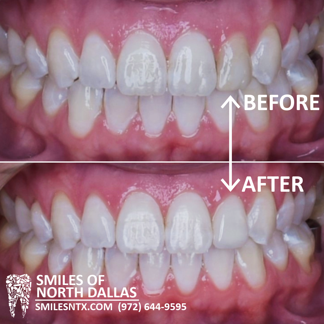 Custom crowns to match shade and shape