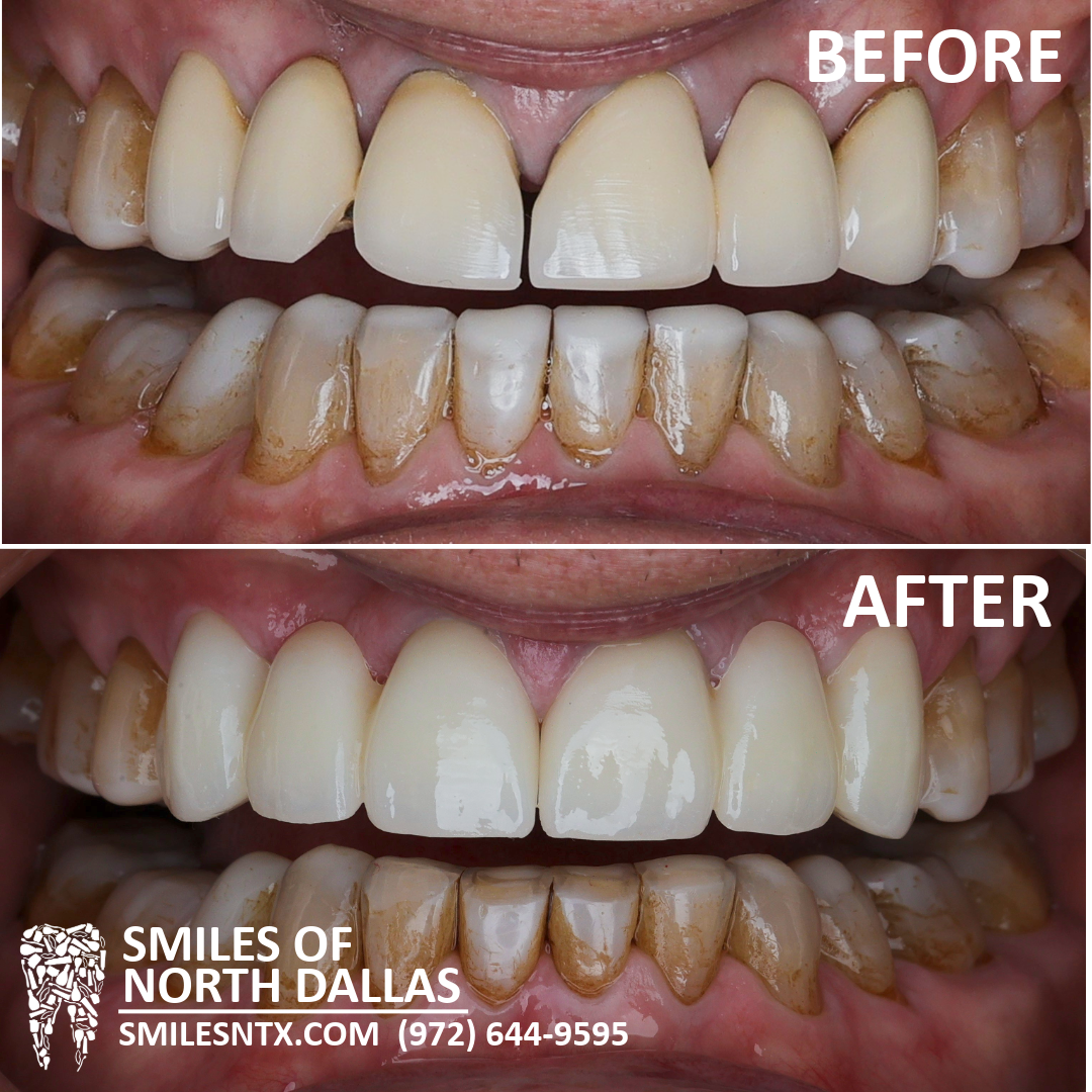 Custom Anterior Veneers