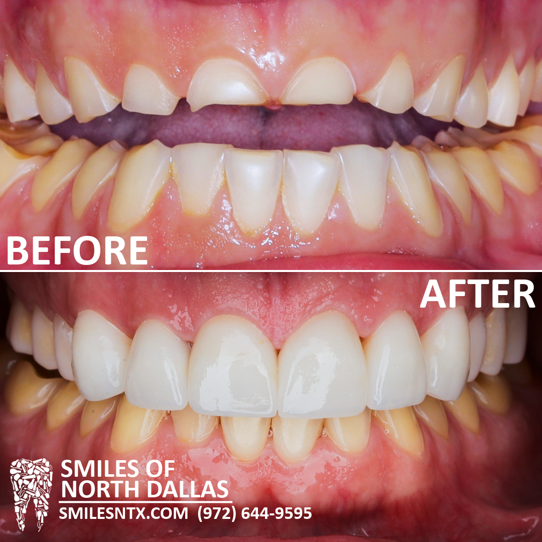 Full Mouth Reconstruction