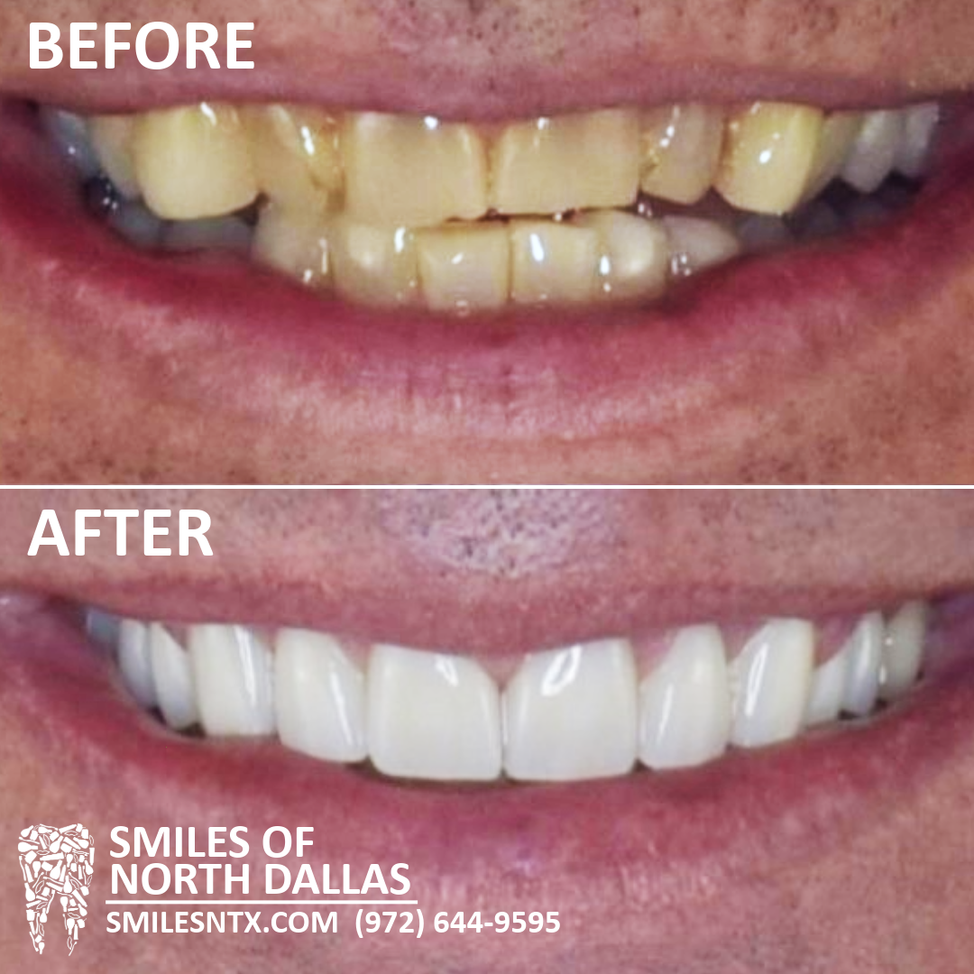 Full Mouth Restoration