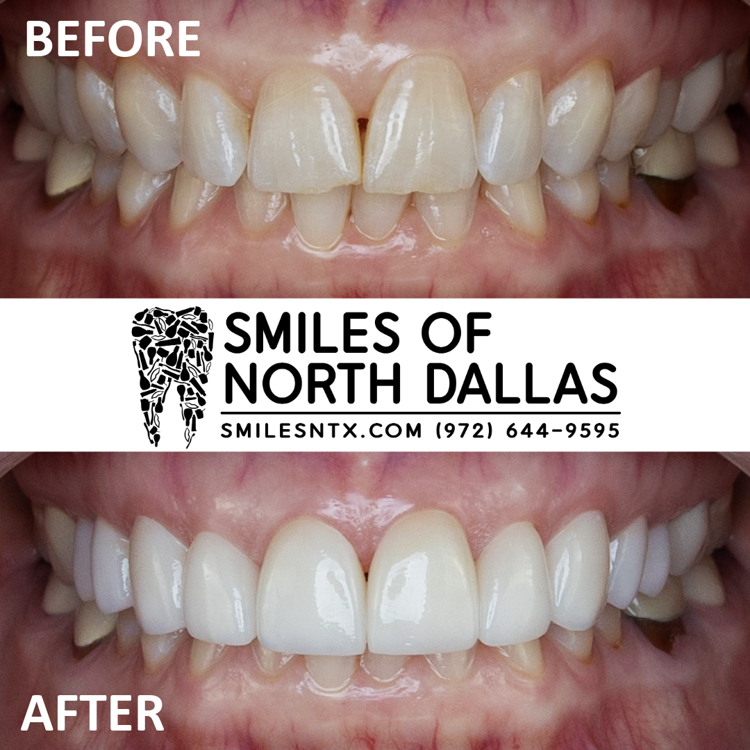 Upper Full Veneers