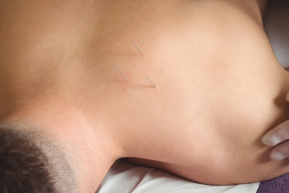 Why Cambridge Chooses Us for Dry Needling