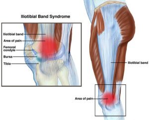 IT Band Syndrome in Runners  Physical Therapy for Runners in DC