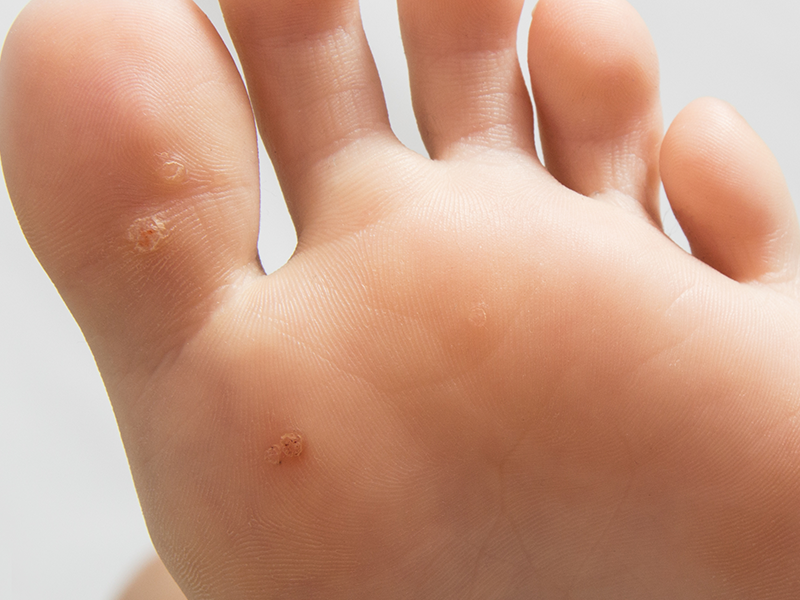 Verrucas (Plantar Warts): Causes, Symptoms and Treatment Explained by a Podiatrist