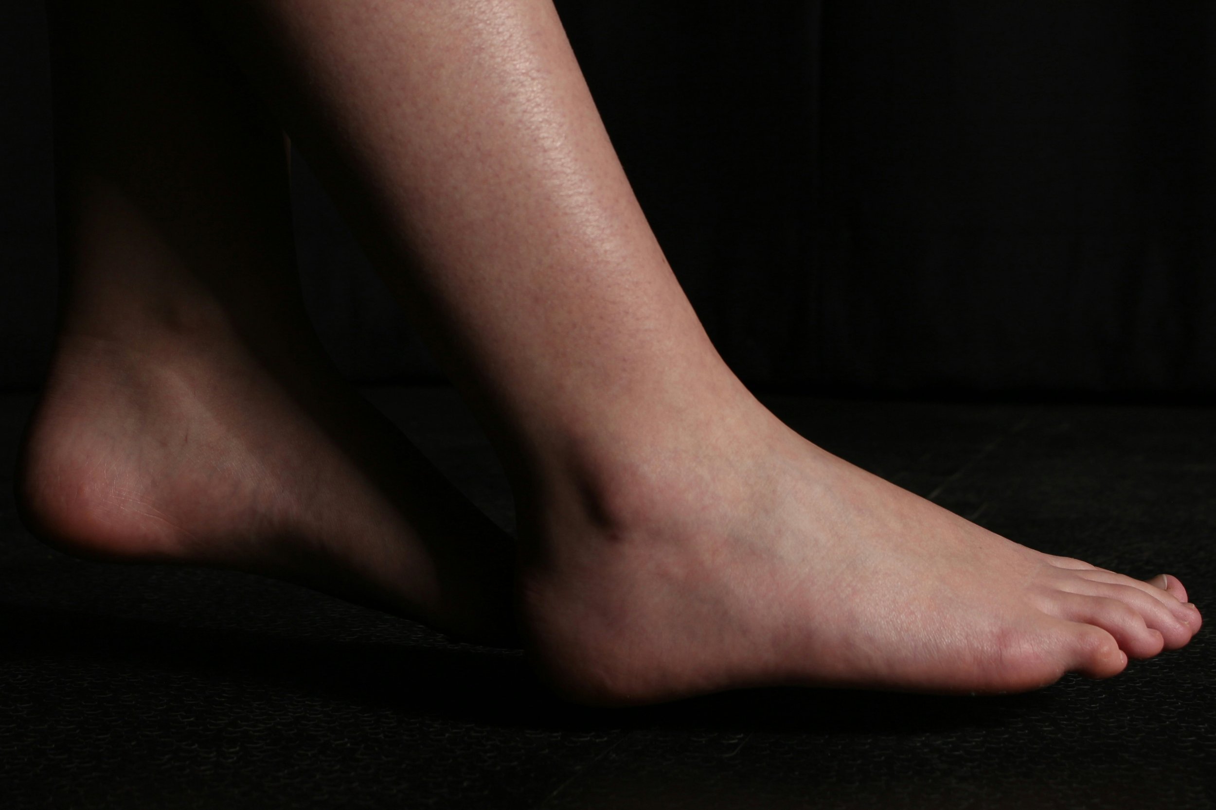 Achilles tendon injury or calf injury? When should I get it checked?