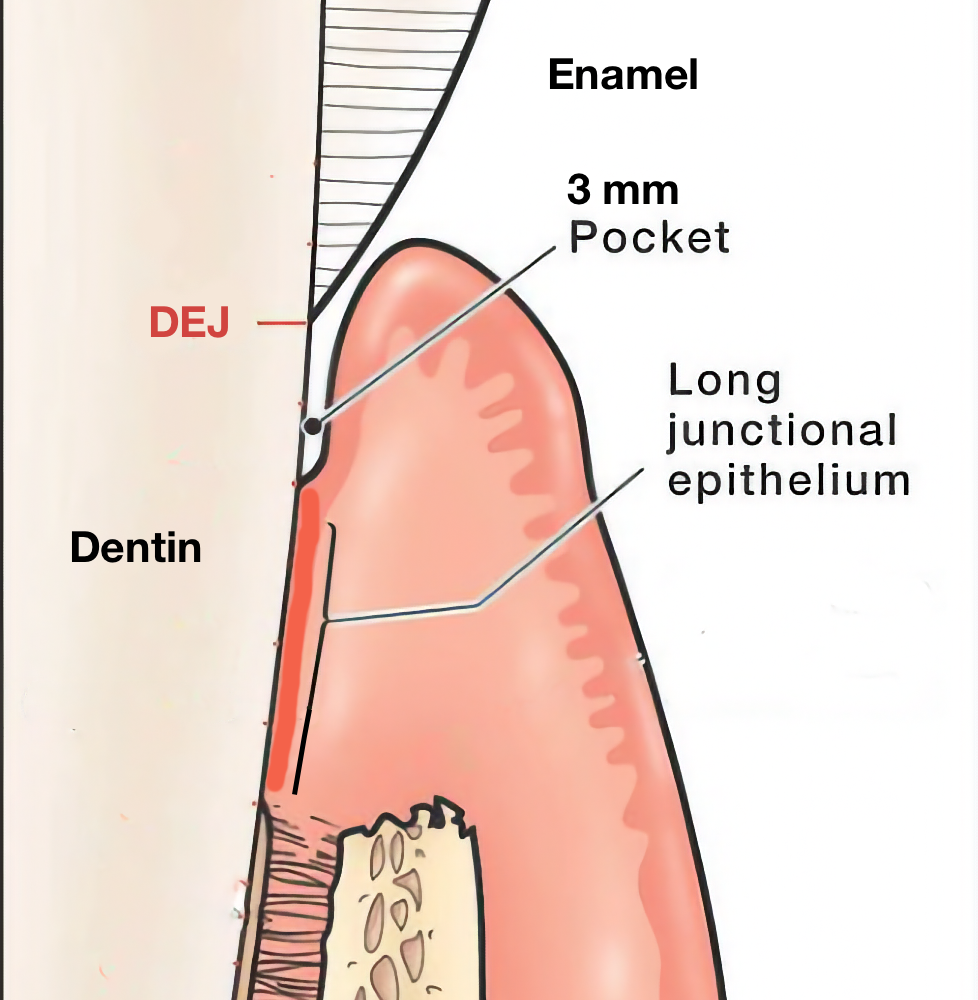 Long Junctional Epithelium