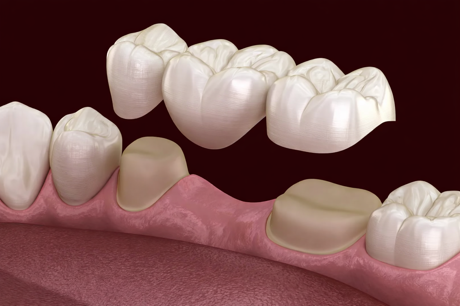 3-Unit Dental Bridge